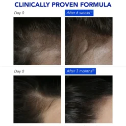 Phytophanere Anti-Reactive Hair Loss Treatment 12x5ml (12x0.17floz)